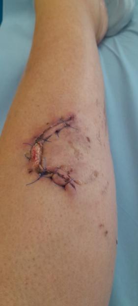 Woman's leg with stitches after dog bite.