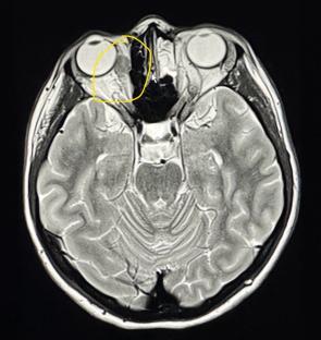 Brain scan showing an orbital tumor.