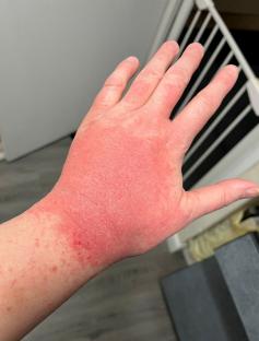 Hand with severe rash.