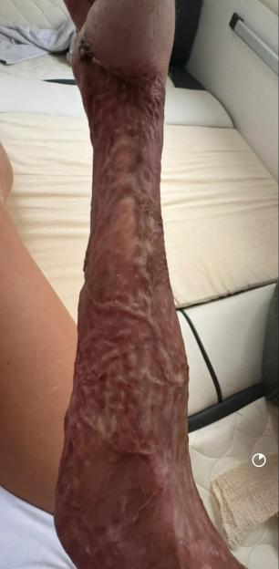 Severely injured arm after a scooter accident.