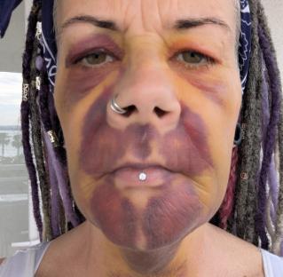 Close-up of a person's severely bruised face after a dental procedure.