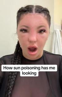 Woman with sun poisoning.
