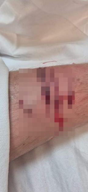 Close-up photo of a leg wound.
