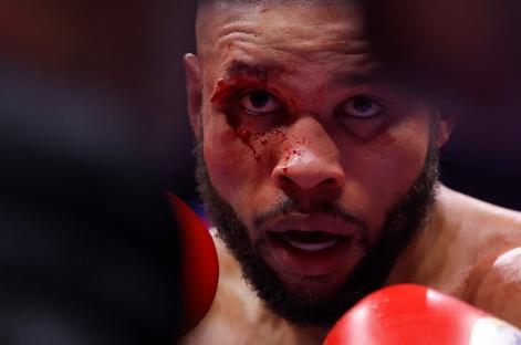 Chris Eubank Jr. with a bloody face during a boxing match.