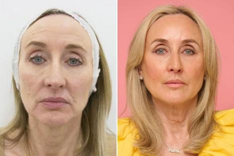An image collage containing 2 images, Image 1 shows Before photo of woman's lower face for dermal filler treatment, Image 2 shows Portrait of a blonde woman wearing a yellow dress and a necklace that says