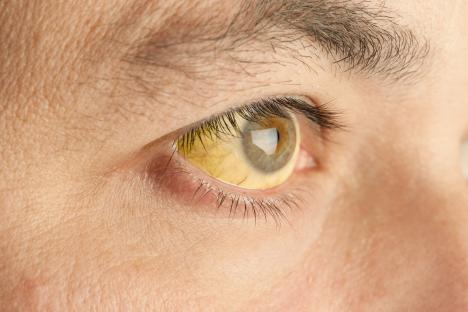 Close-up of eye with jaundice.