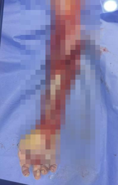 Severely injured arm after a motorcycle accident.