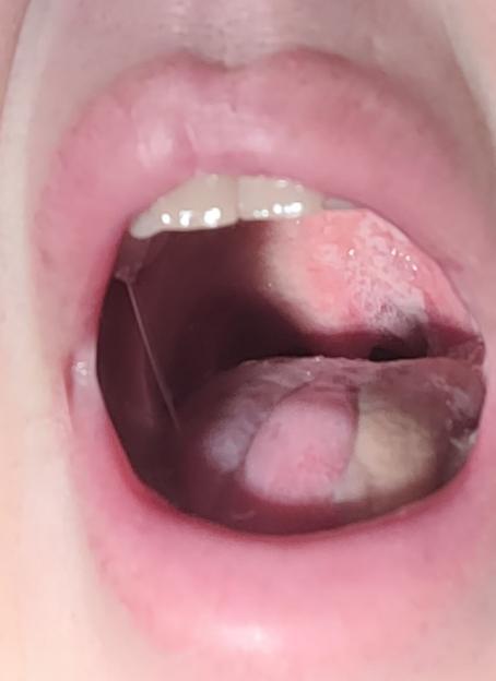 Close-up image of a person's tongue with a white patch.