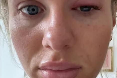 Chloe Burrows sparks concerns as she sports swollen eye as Love Island star responds to fans