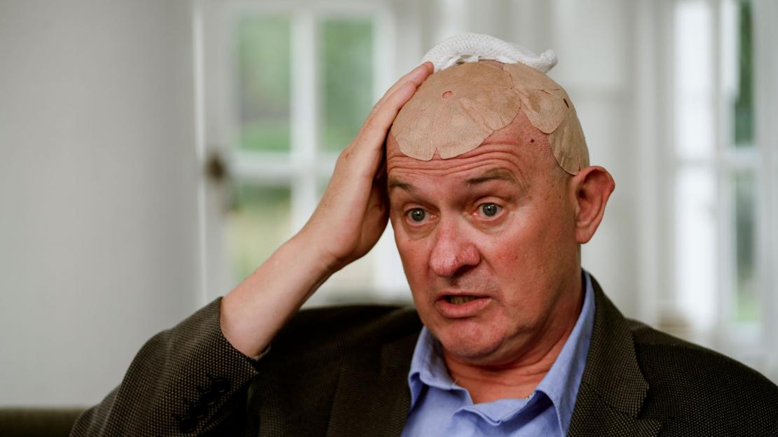 Man with brain cancer with Optune Gio patches and device on his head.