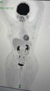 FDG PET CT scan showing areas of potential cancer.