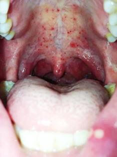 Close-up image of a throat with group A streptococcal pharyngitis.