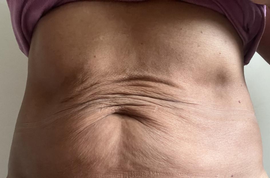 Close-up of wrinkled abdomen.