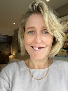 Close-up portrait of a woman smiling, showing a missing tooth.