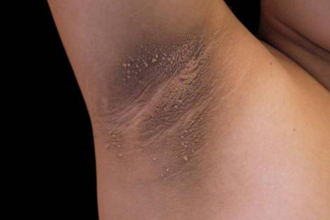 Close-up of darkened, textured underarm skin.