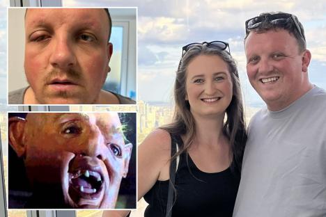 Dad’s ‘pink eye’ turned out to be killer infection that left him looking like ‘Sloth from The Goonies