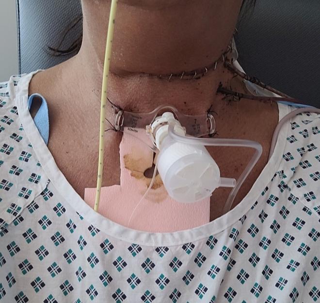 Close-up of a woman's neck post-surgery, showing stitches and medical tubes.