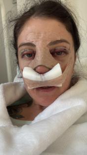 Close-up of a woman's face post-eyelid and nose surgery, with bandages.