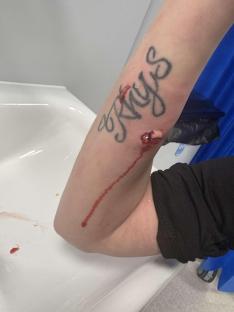 Bloody arm wound.
