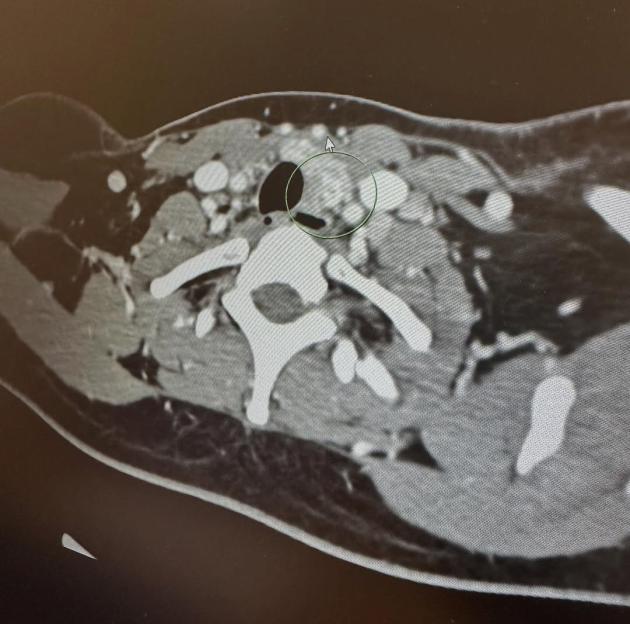 CT scan of neck showing cancerous lymph node.