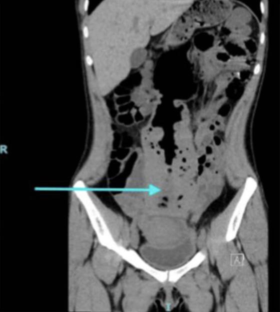 CT scan showing massively distended colon.