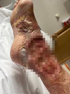 Close-up photo of a severely infected foot wound.