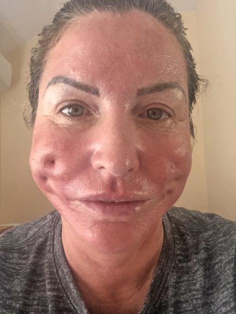 Leigh Cobb with a red, puffy face with visible dimples on her cheeks, days after surgery.