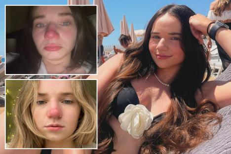 My nose is permanently red after sunburn 5 years ago – strangers make comments but even doctors are baffled