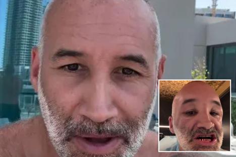 Dane Bowers reveals new Turkey Teeth after having them shaved down to pegs for makeover