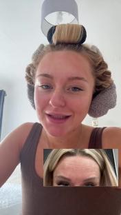 Woman with hair rollers showing before and after forehead wrinkles.