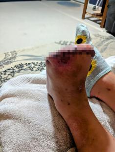 Close-up photo of a woman's foot after a partial amputation due to an infected ingrown toenail.