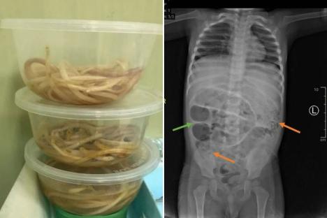 Toddler’s ‘constipation’ turns out to be giant worms crawling through his guts that he ended up vomiting up