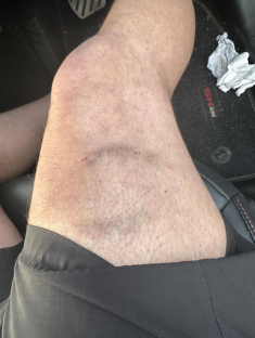 Bruises on a man's thigh.