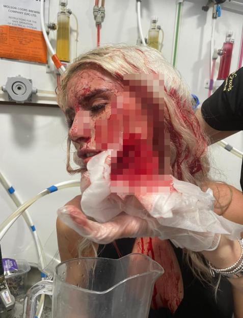 Woman with severe facial injuries from a glassing.