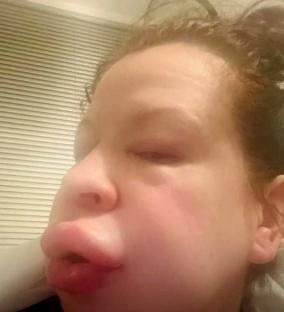 Severe allergic reaction rash on a person's legs.