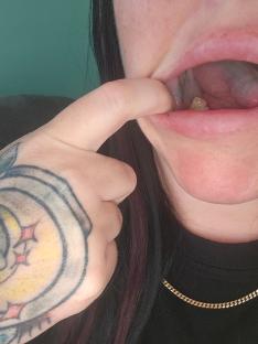 Close-up of a person's mouth showing a loose filling.