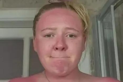 Woman who ‘didn’t believe the UV rating’ & skipped SPF unveils sunburn & people can ‘feel the heat through the screen’