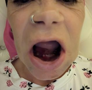 Close-up of a person's mouth showing bleeding gums and missing teeth after dental surgery.