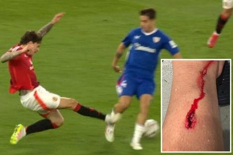 Athletic Bilbao star shows off horror gash as wild Lindelof challenge leaves him needing stitches after Man Utd clash