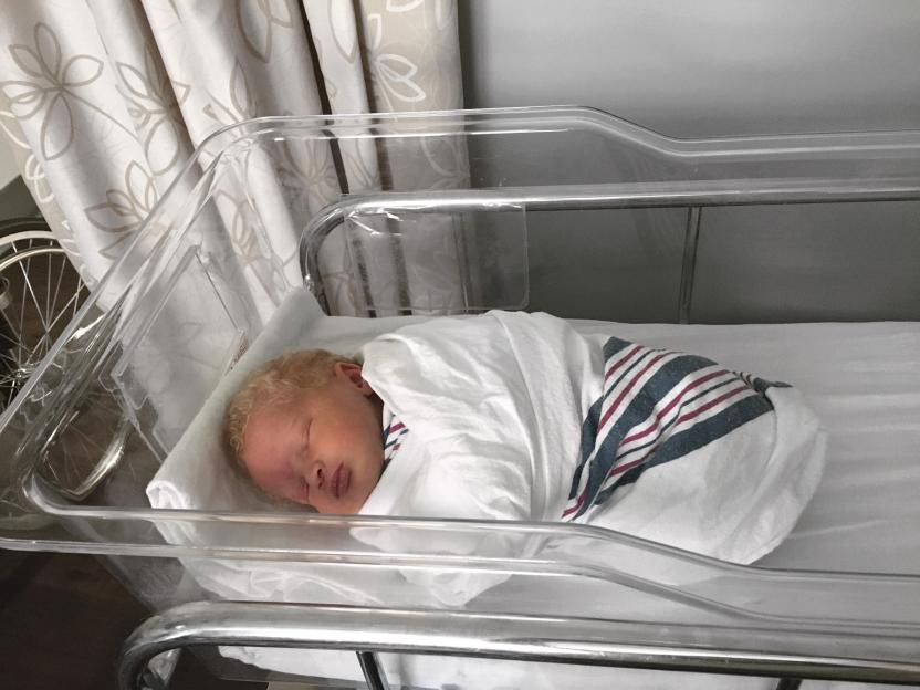 Newborn baby with albinism sleeping in a hospital bassinet.
