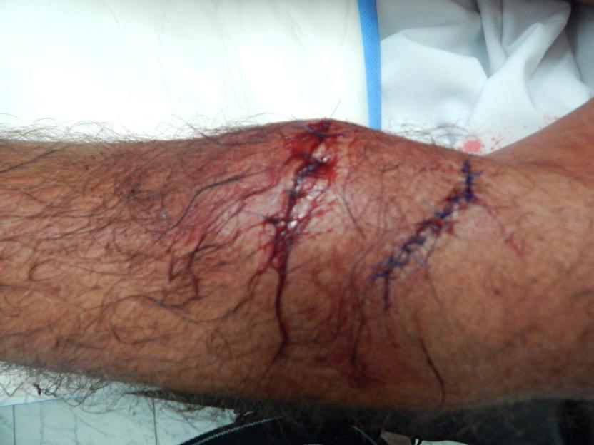 Close-up of a person's arm with two lacerations stitched together with blue thread, one on the forearm and one near the elbow, both bleeding.