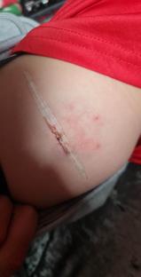 Child's arm with a long, bandaged wound.