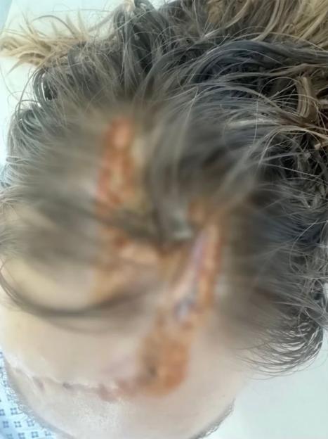 Close-up of a scalp wound.