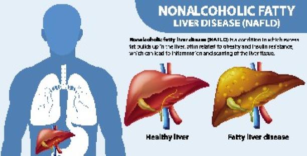 Nonalcoholic Fatty Liver Disease (NAFLD) illustration