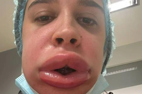 My slim lips ballooned like a blobfish after having filler REMOVED – I was crying & drooling all over myself 