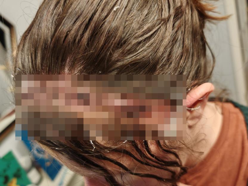 Close-up of a person's head and shoulders; a portion of the scalp is pixelated.