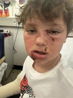 Eight-year-old boy with facial injuries after a dog attack.