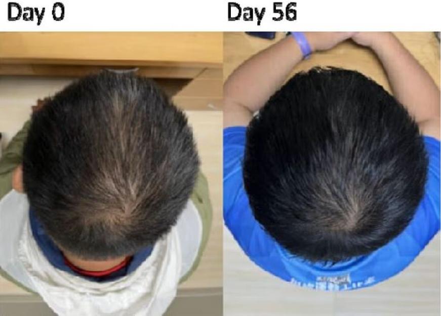Collage of two overhead photos showing a person's hair loss before and after 56 days of treatment.