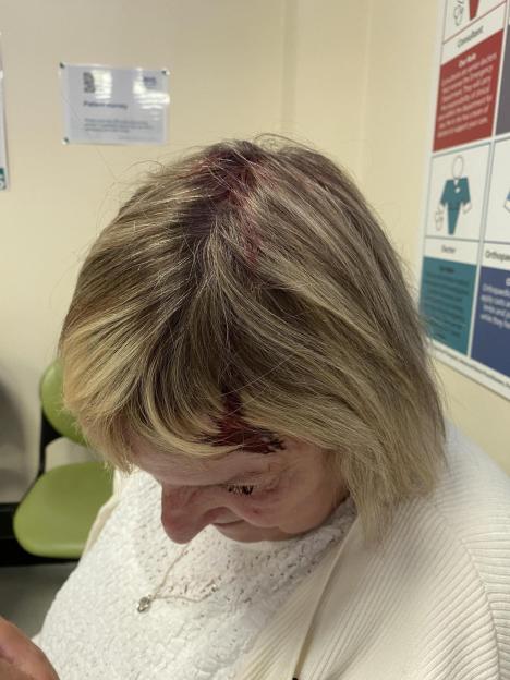 Woman with a head wound after a seagull attack.