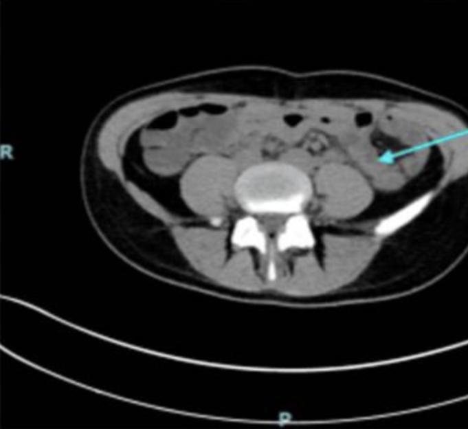 CT scan showing a massively distended colon.